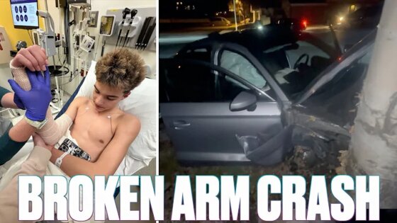 ARM BROKEN IN TWO PLACES AFTER SCARY CAR CRASH ONE DAY BEFORE FACE SURGERY